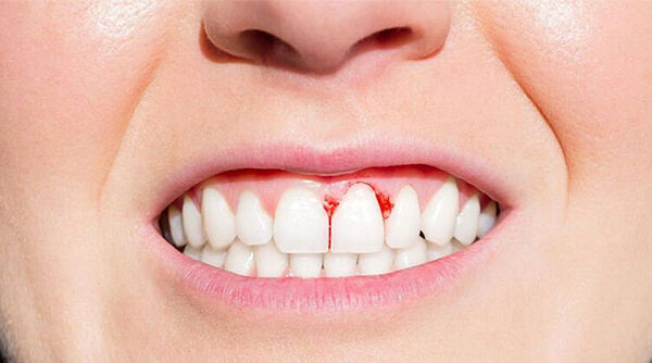 Nguyên nhân gây bệnh viêm răng lợi