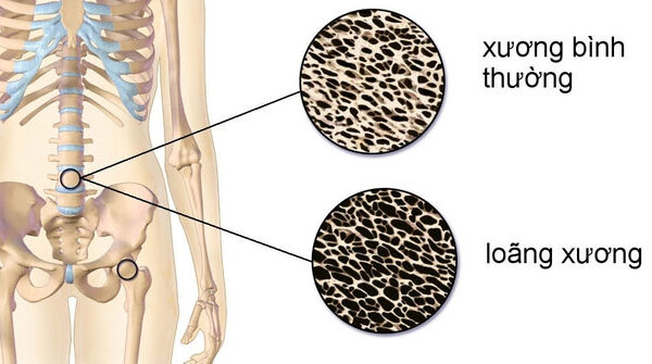 Top 4 loại thực phẩm là “Vua ăn cắp canxi”, khiến nhiều người ngã nhẹ đã gãy xương
