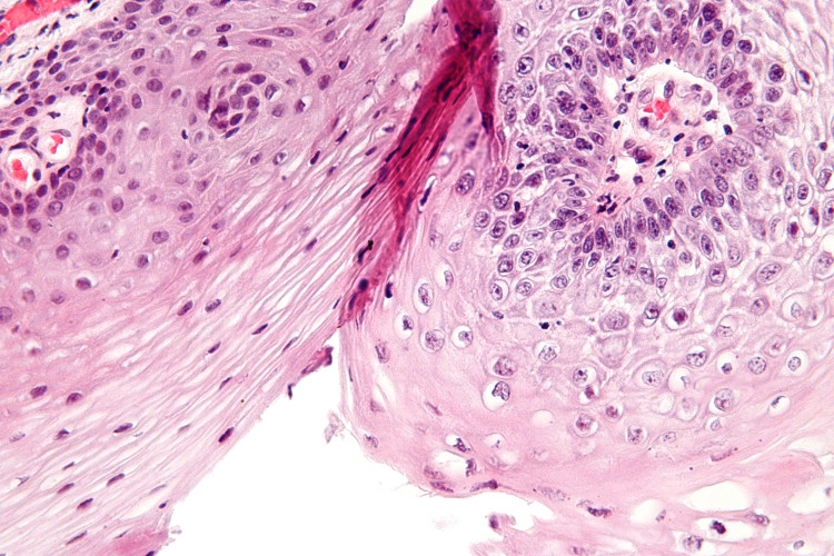 virus-hpv Thời gian ủ bệnh của sùi mào gà thường là 3 tuần đến 8 tháng.