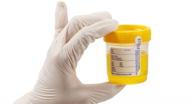 Glucose là dấu hiệu hay gặp ở bệnh nhân tiểu đường.